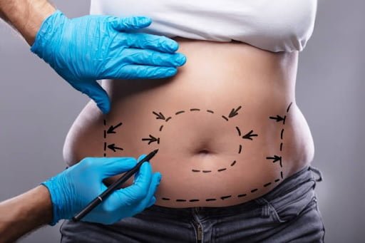 liposuction surgery