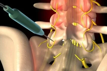 How Radiofrequency Ablation Can Bring You Lasting Relief